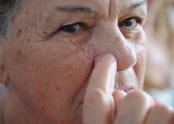 Tecnologia para tratar câncer de pele é aprovada para uso no SUS