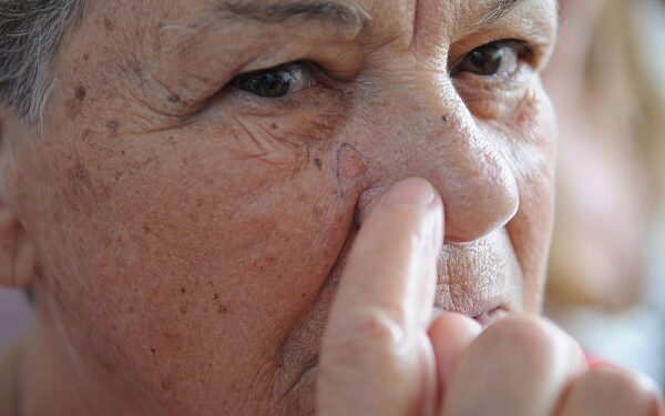 Tecnologia para tratar câncer de pele é aprovada para uso no SUS